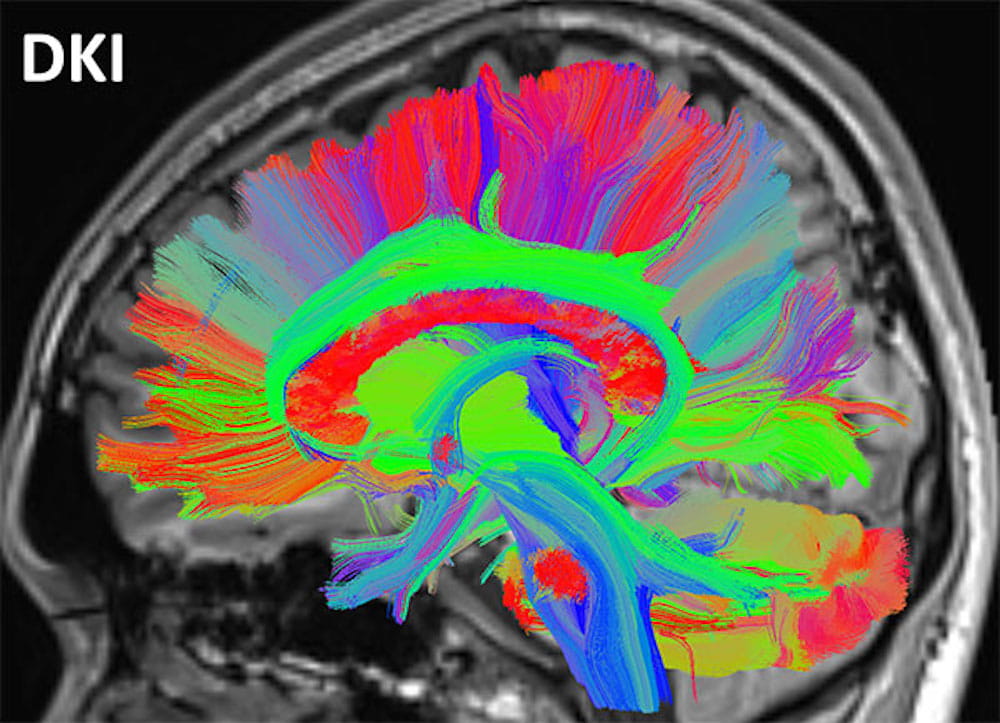 Concussion Brain Image DKI