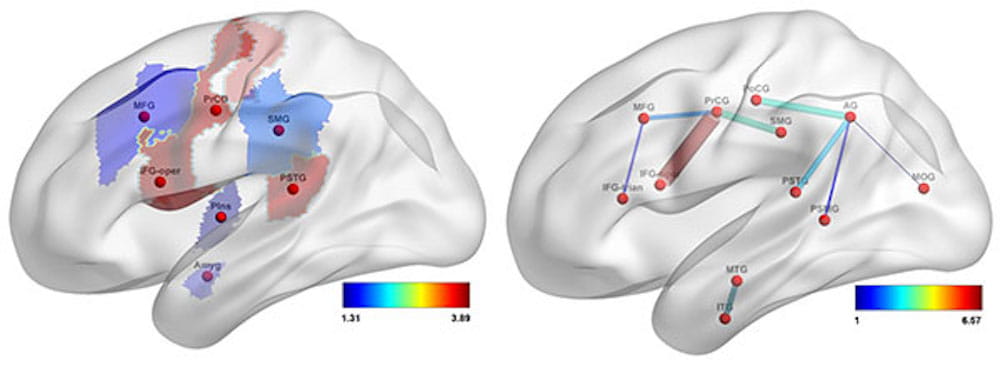 Brain Illustration predicting language deficits