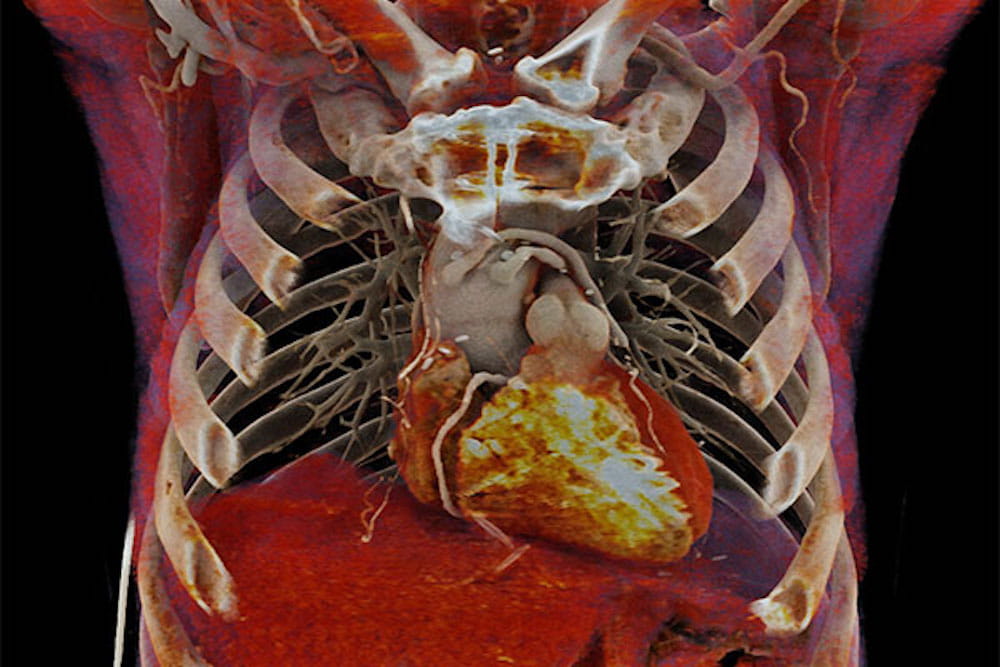 Chest cavity imaging of heart