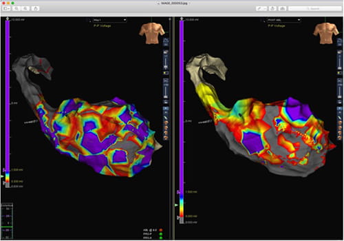 Imaging of a heart using different colors to indicate health of tissue