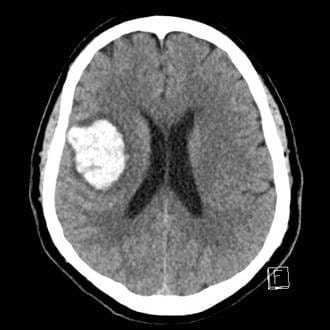 black and white image of Corbin's brain showing blood pooling in one section