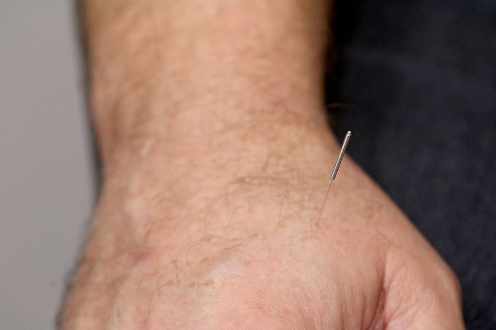 closeup of acupuncture needle in a hand