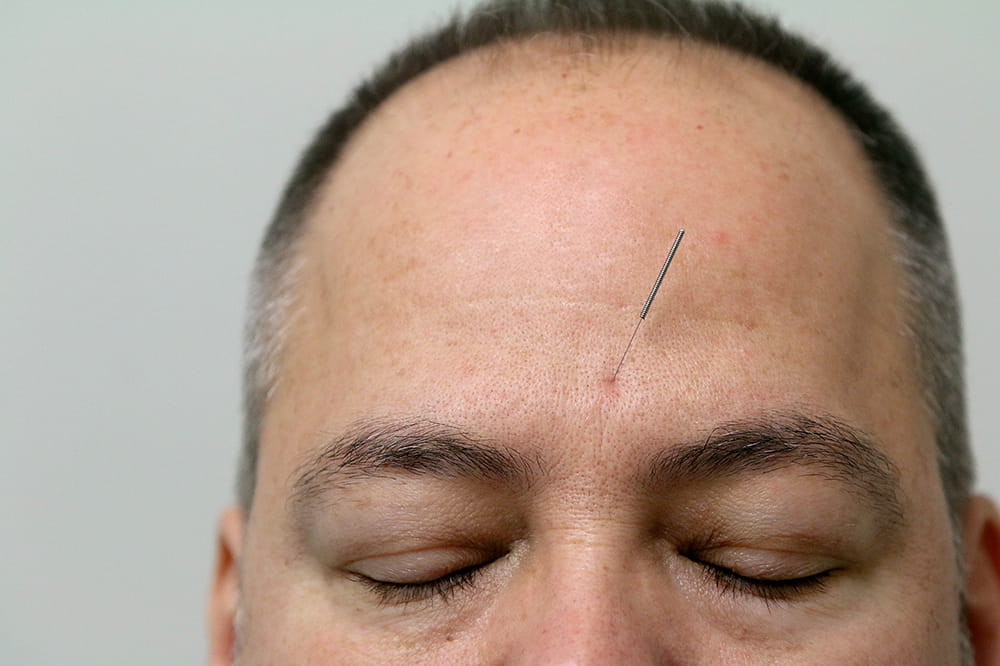 closeup of acupuncture needle in a forehead