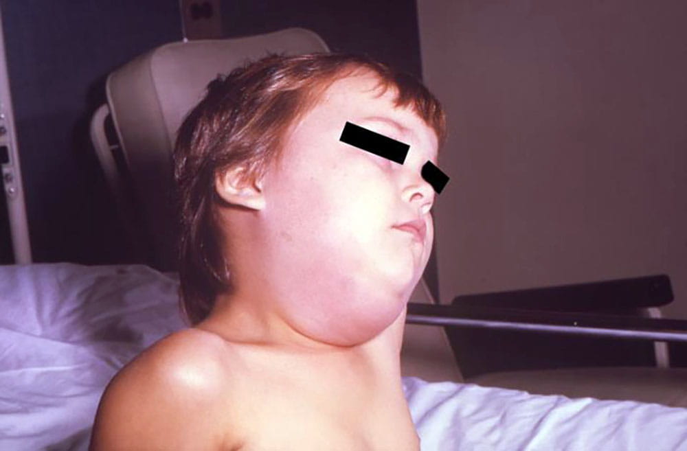 CDC photo of boy with mumps