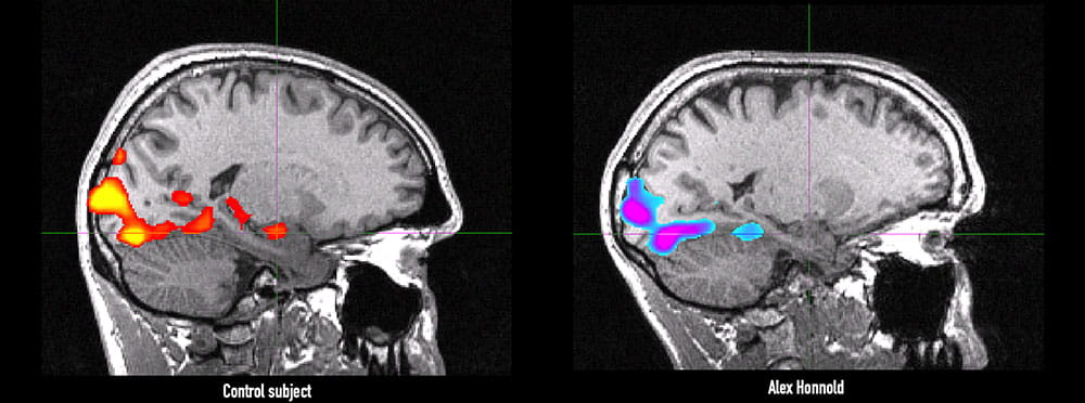 Alex Honnold's brain scan versus a control brain scan