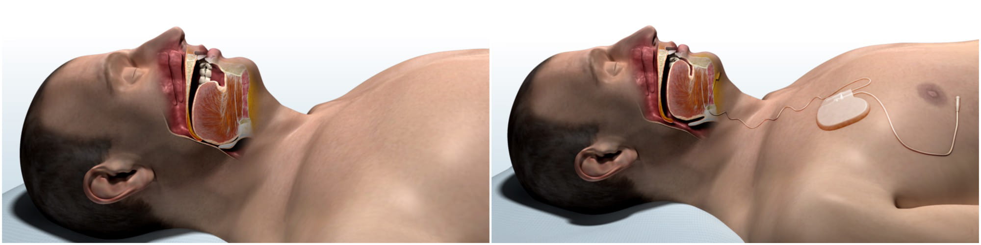 computer generated drawings of the anatomy of a man's throat and mouth during sleep