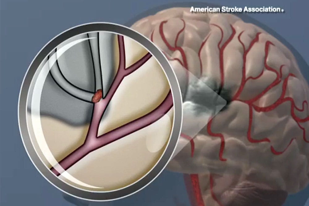 This image from the American Stroke Association shows blood flow blocked in the brain.