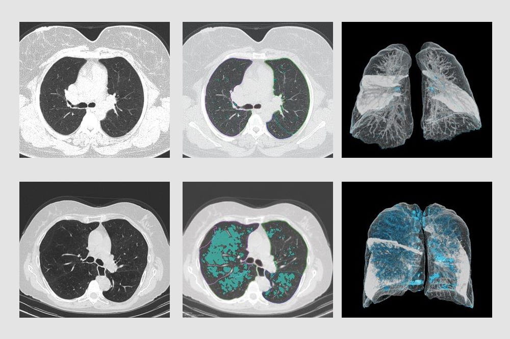 A series of images in 2D and 3D showing the lungs of two people with emphysema