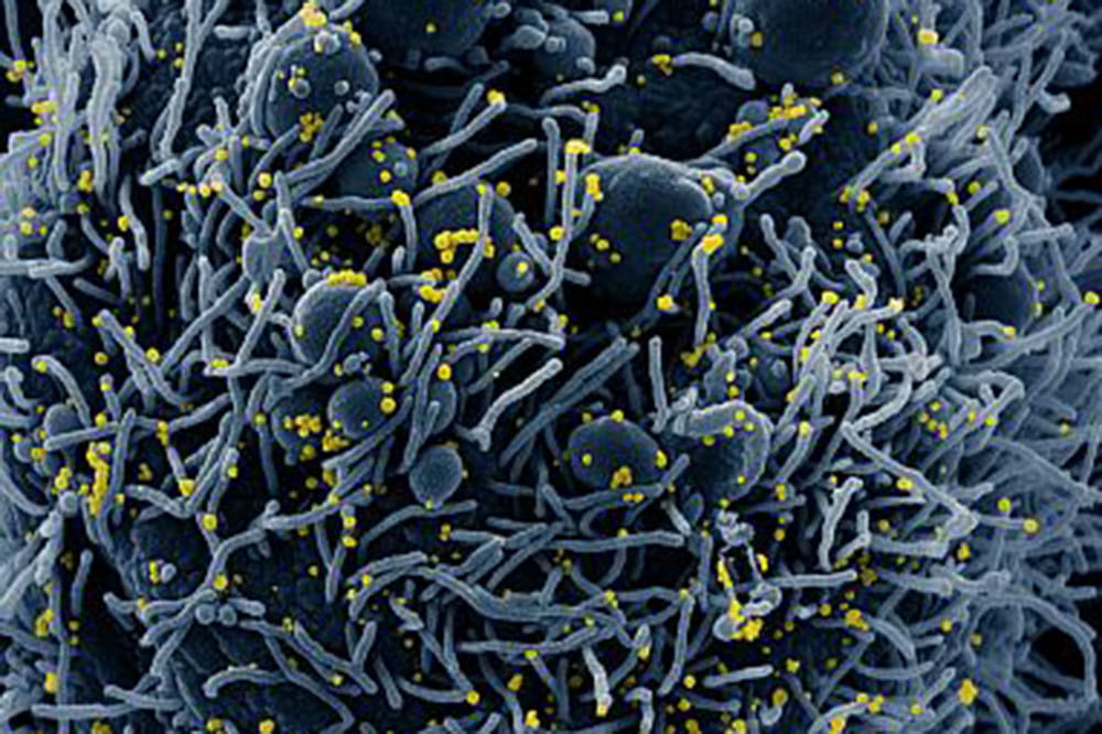Colorized scanning electron micrograph of a cell infected with coronavirus particles.