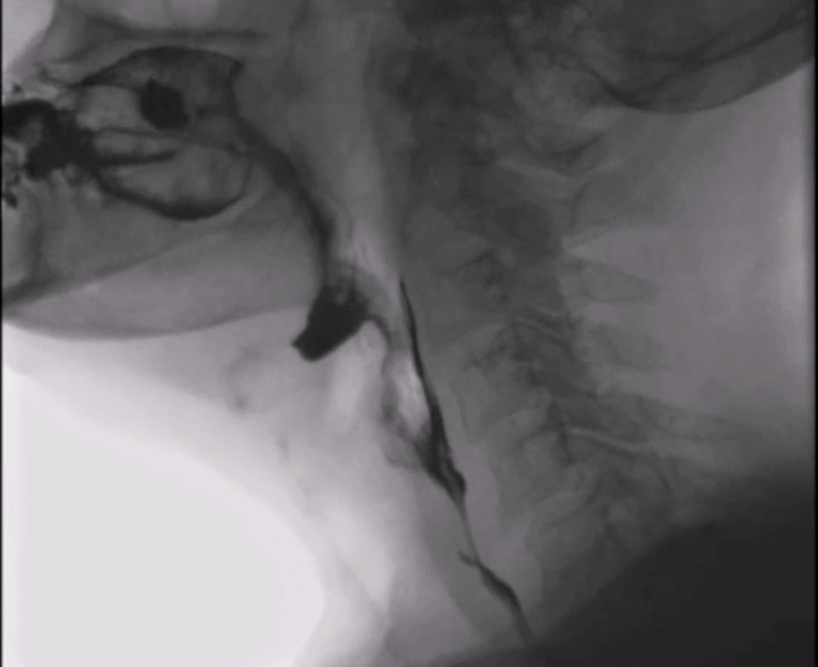 Screenshot of Normal barium swallow animation, from Wikimedia commons. Animation by Anka Friedrich of original image by Normaler Schluck.  CC 4.0 license.