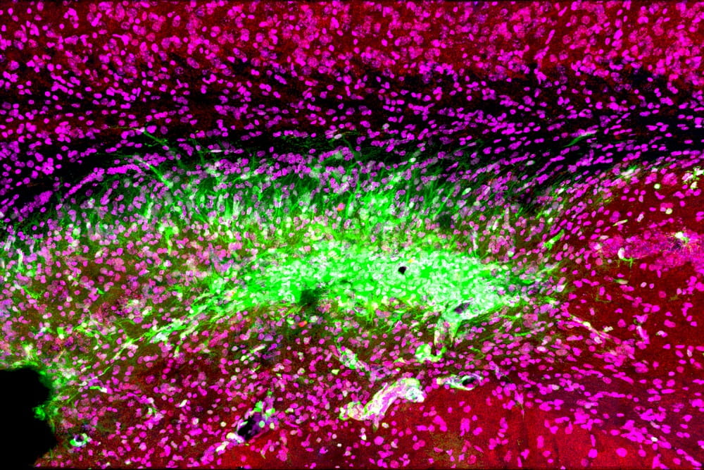 Even after opening an occluded vessel after stroke, this figure shows that the immune cells in the brain (Green) continue to attack synapses (red) and neurons (Magenta) in the memory center of the brain, the hippocampus, at least for 30 days after stroke. Image courtesy of Dr. Stephen Tomlinson.