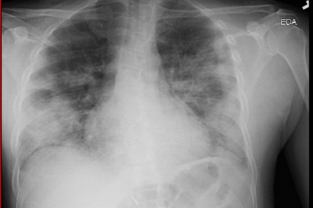 X-ray of Albert Jordan's lungs
