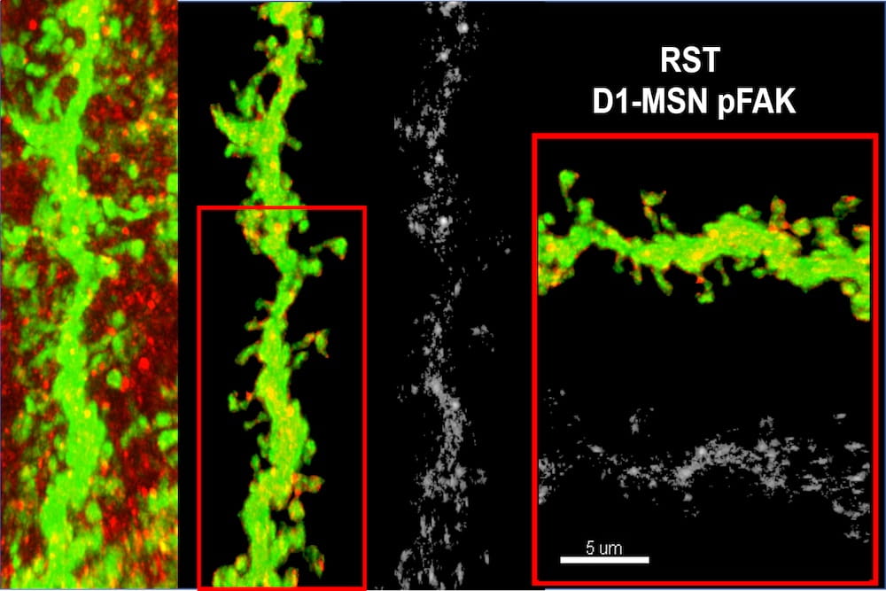 High-resolution confocal micrographs of enlarged dendrites (green) in the D1-medium spiny neurons (D1-MSN) of the nucleus accumbens of an animal after drug reinstatement (RST). The nucleus accumbens is a brain structure important to motivation.