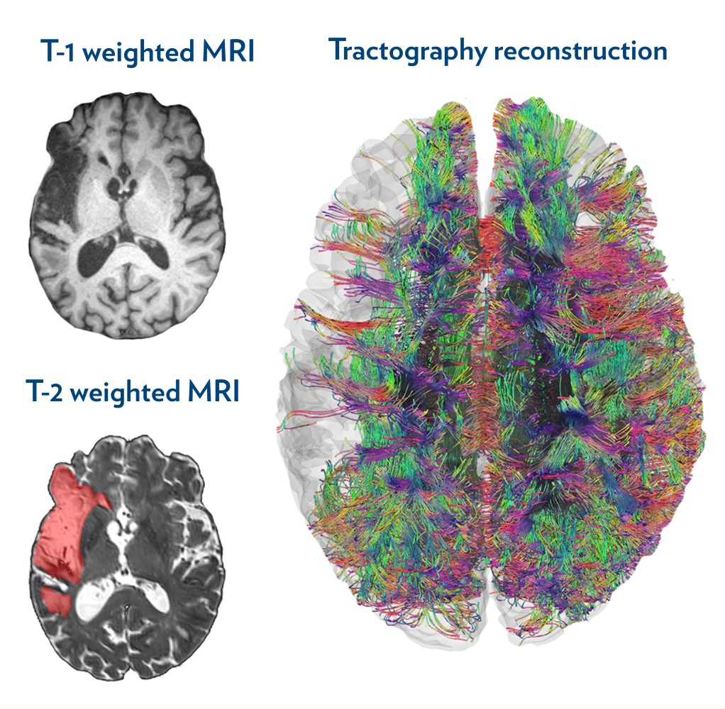 the image shows three different views of the brain using different types of MRI