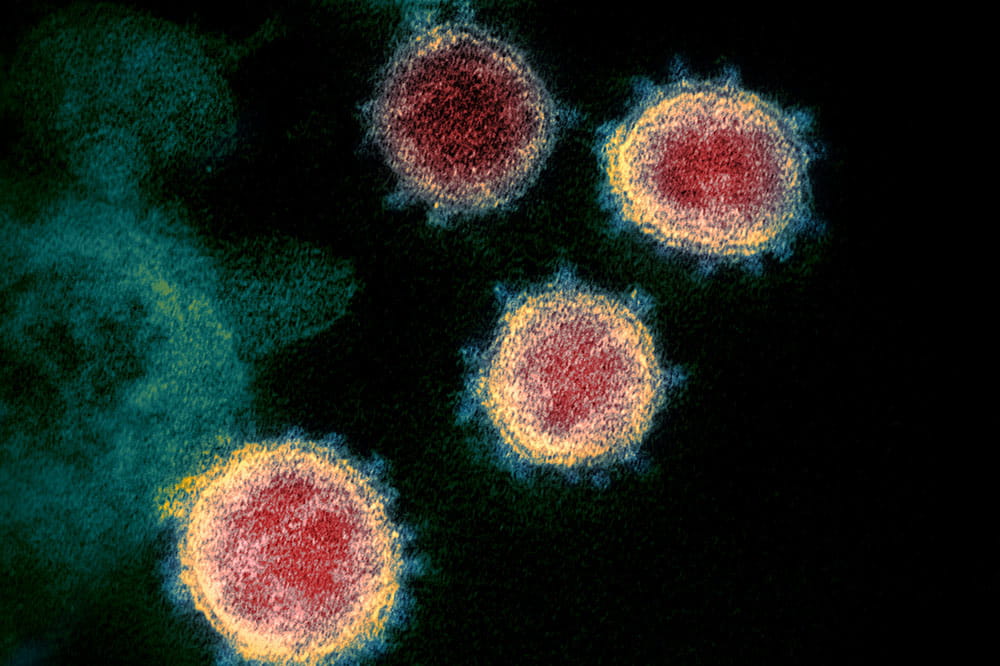 This microscopic view shows the virus that causes COVID-19, found in a patient in the U.S. 