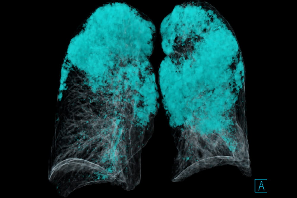 An image of diseased lungs as they show up on the artificial intelligence radiology software