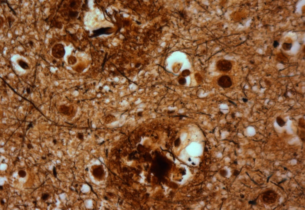 Amyloid plaques in the brain of a person with Alzheimer's disease