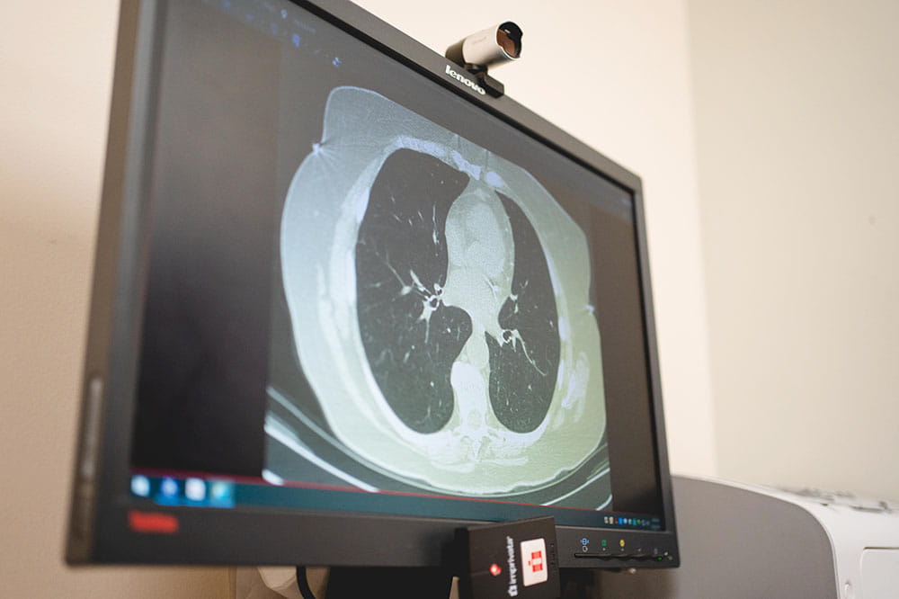 computer monitor showing image of a lung cancer scan
