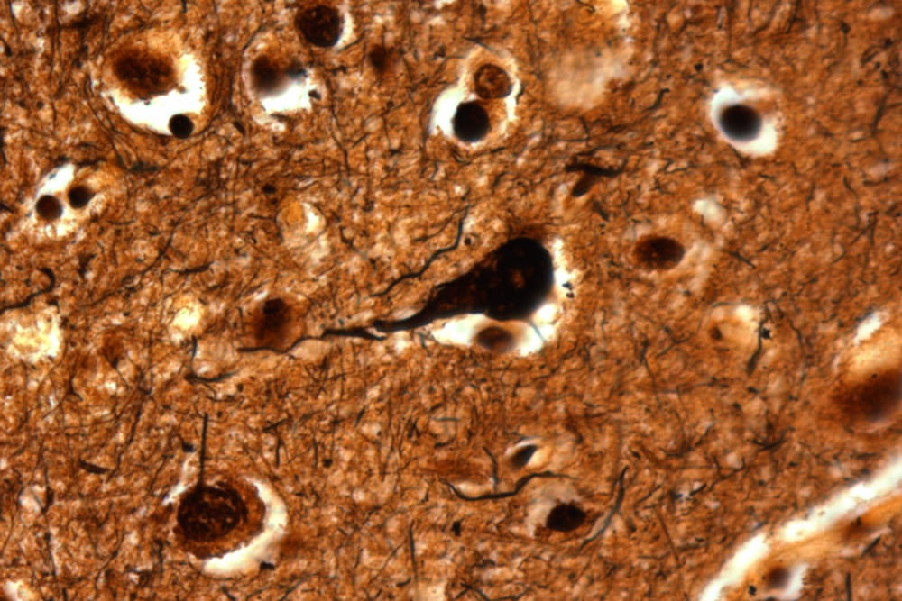 Brain tissue showing a flame-shaped neurofibrillary tangle in the center