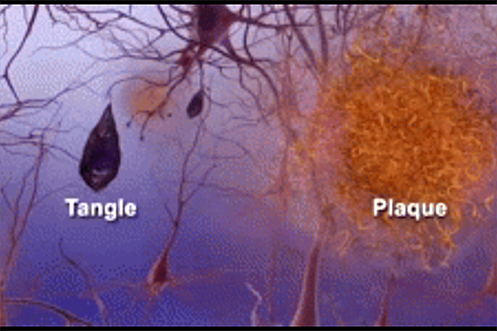 What a doctor who has tested new Alzheimer's drug wants you to know