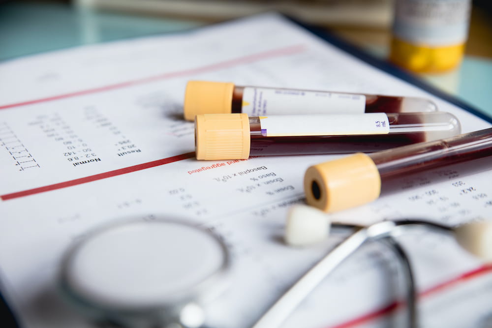 a close up of three vials containing blood sitting on top of a chart next to a stethoscope
