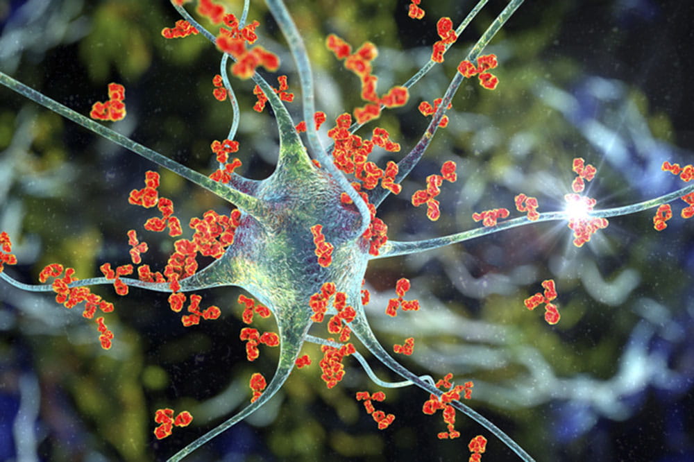 Antibodies attacking neuron in 3D illustration. Concept of autoimmune neurologic diseases. iStock
