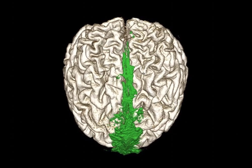 MRI showing the dorsal flow of the brain’s waste clearance system (shown in green).