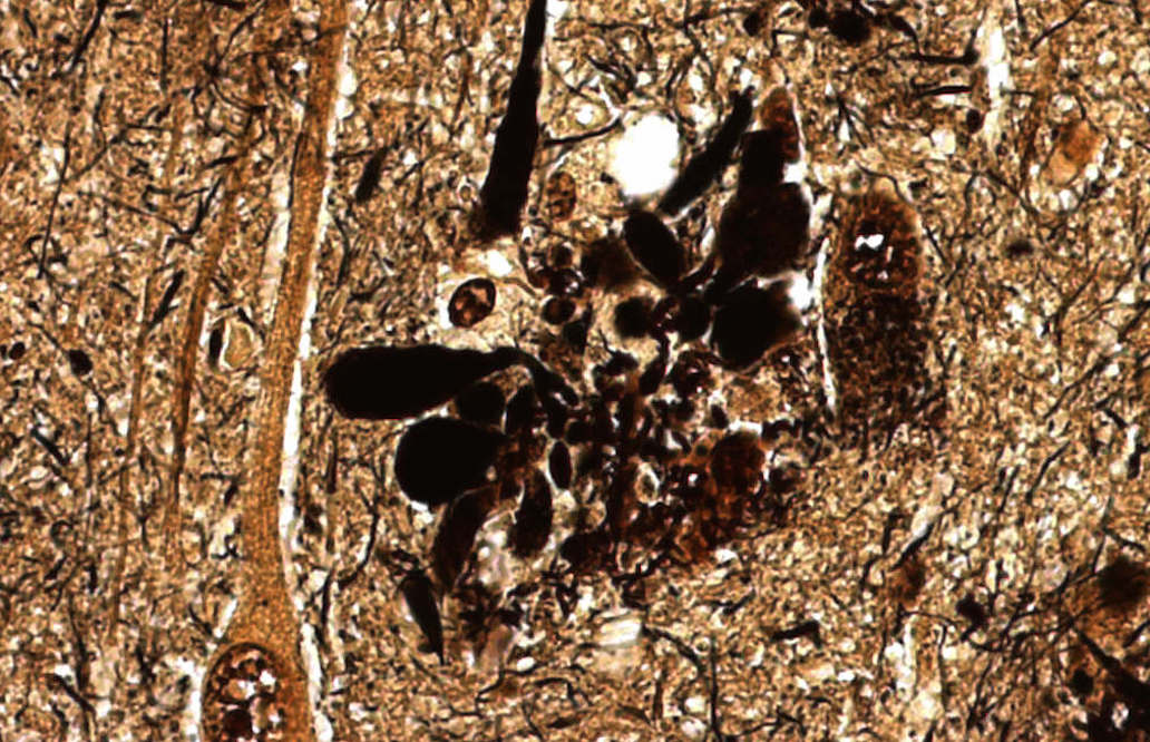 A neuritic plaque, one of the hallmarks of Alzheimer's. Image courtesy of Dr. Steven Carroll of MUSC.