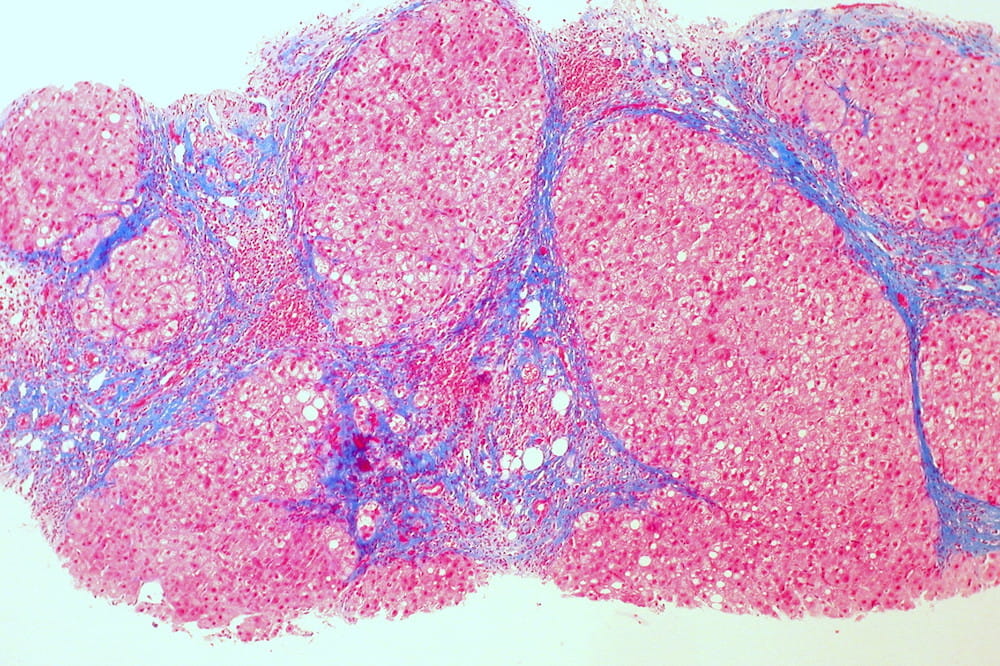Micrograph of a liver sample with trichrome stain, showing cirrhosis as a nodular texture surrounded by fibrosis (collagen is stained blue). Image  courtesy of Ed Uthman at flickr. Creative Commons License 2.