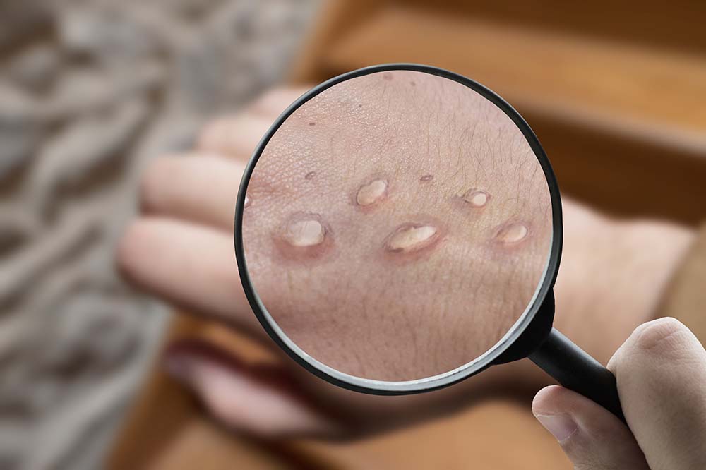 A magnifying glass focusing on a vesicle rash created by monkeypox. iStock