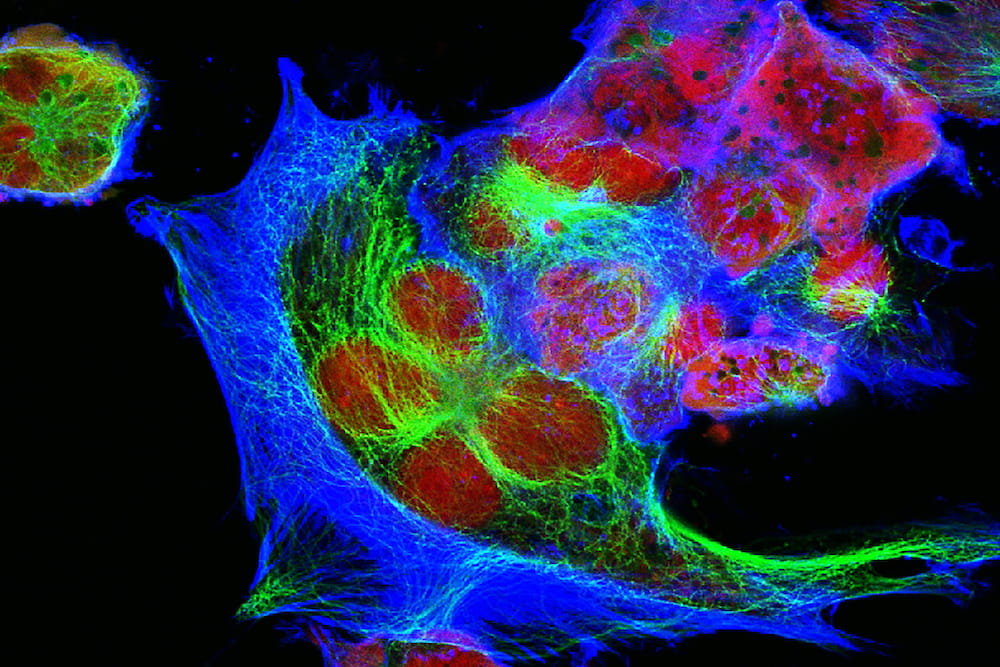 Real fluorescence microscopic view of human neuroblastoma cells. Licensed from iStock.