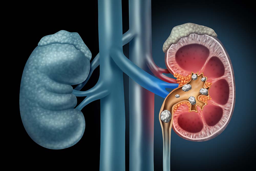 Illustration of kidneys on a black background. The one on the right is red and has a series of small kidney stones, including one blocking a passage. iStock
