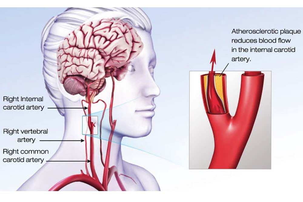 Illustration of woman's head showing arteries leading to her brain.