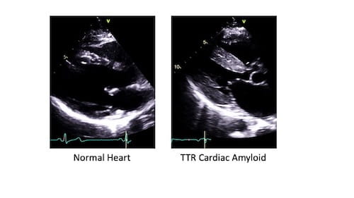In the pictures above, the heart on the right has TTR amyloid. This makes the heart brighter and thicker. With amyloid in the heart, squeezing and relaxing is not as good as for a normal heart. Image courtesy of Dr. Daniel Judge