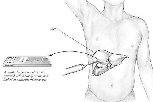 Illustration of a liver biopsy.