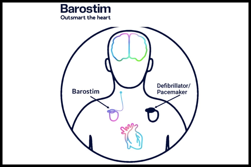 Drawing of a person's torso and head. At the top it says Barostim outsmart the heart. In the body,  you see drawing of the brain and two pieces of the Barostim device.
