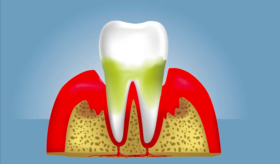 Tooth with green at the gum line. The gums are separated from part of the tooth and look red.