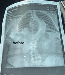 Bluffton teen Addy Powell pre-scoliosis surgery