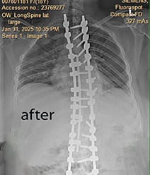 Addy Powell post-scoliosis surgery