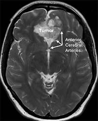 An image from above of a brain with a tumor toward the top.