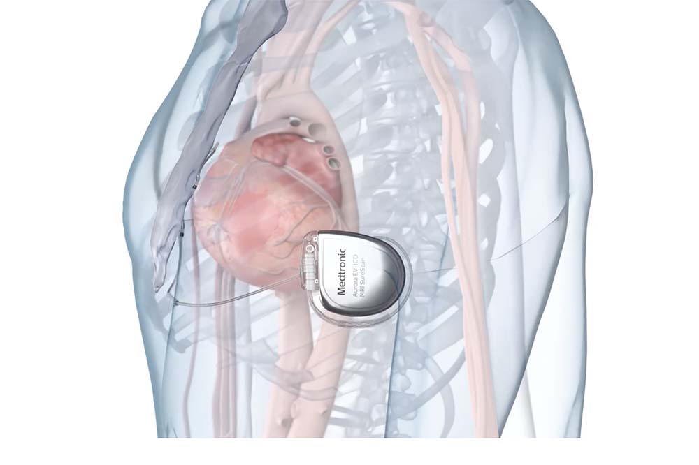 Illustration of a torso highlighting a pink heart and a small metal device that says Medtronic.