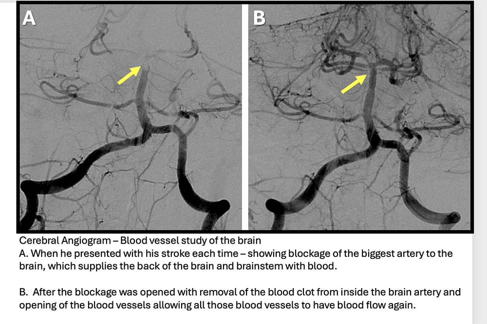 Side by side images of blood vessels in the brain. Arrows point to a place where Jayden Schnall's artery was blocked. Below, it says: Cerebral Angiogram - Blood vessel study of the brain A. When he presented with his stroke each time - showing blockage of the biggest artery to the brain, which supplies the back of the brain and brainstem with blood. B. After the blockage was opened with removal of the blood clot from inside the brain artery and opening of the blood vessels allowing all those blood vessels to have blood flow again.