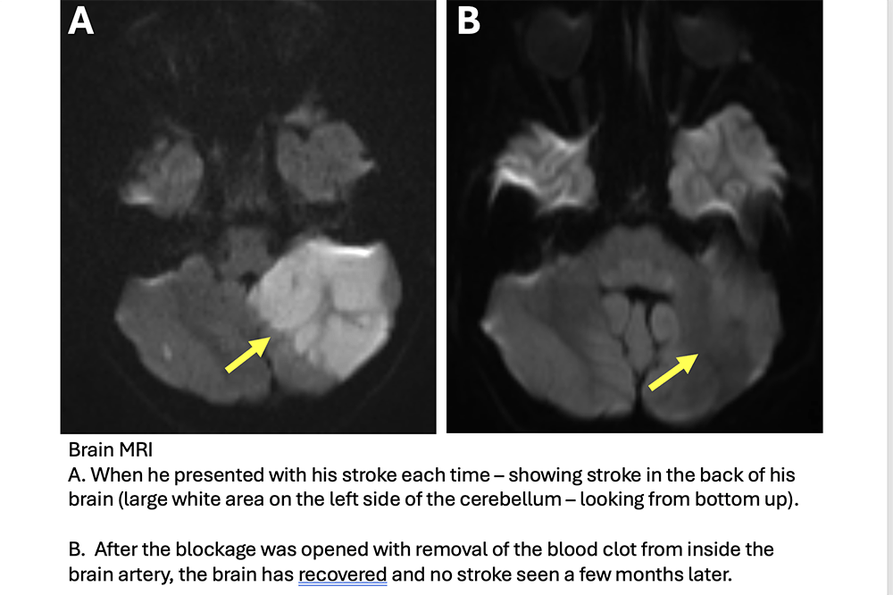 Side by side images of Jayden Schnall's brain. Below them are the words: Brain MRI A. When he presented with his stroke each time - showing stroke in the back of his brain (large white area on the left side of the cerebellum - looking from bottom up). B. After the blockage was opened with removal of the blood clot from inside the brain artery, the brain has recovered and no stroke seen a few months later.