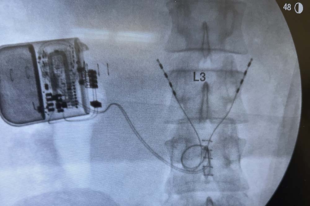 A scan showing a small device on the left linked to a cord that goes into the spine.