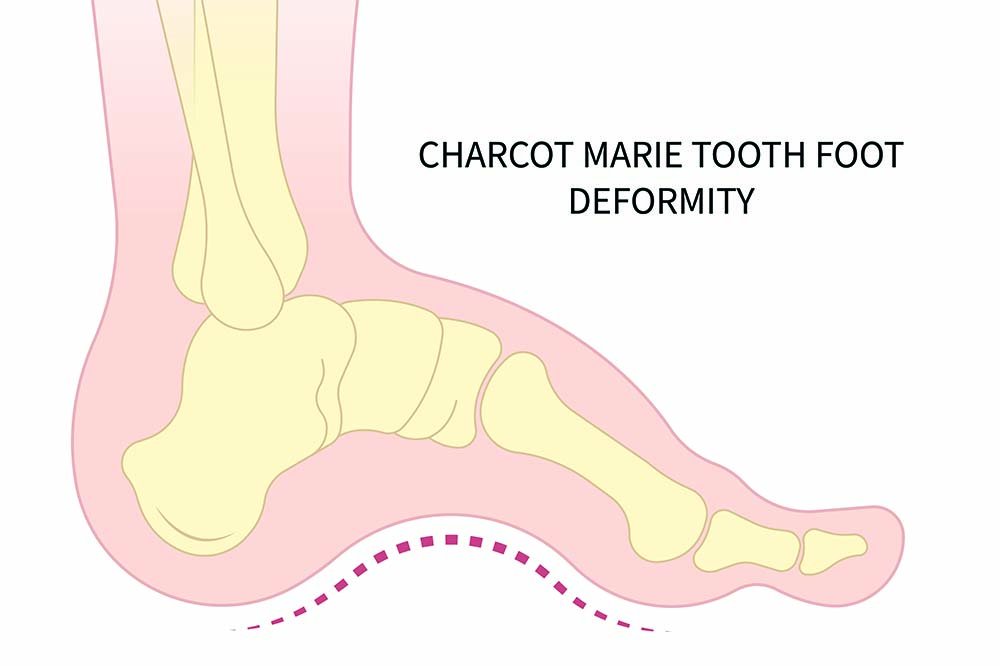 illustration of a foot that has a very high arch. The words Charcot Marie Tooth foot deformity are on the right side.