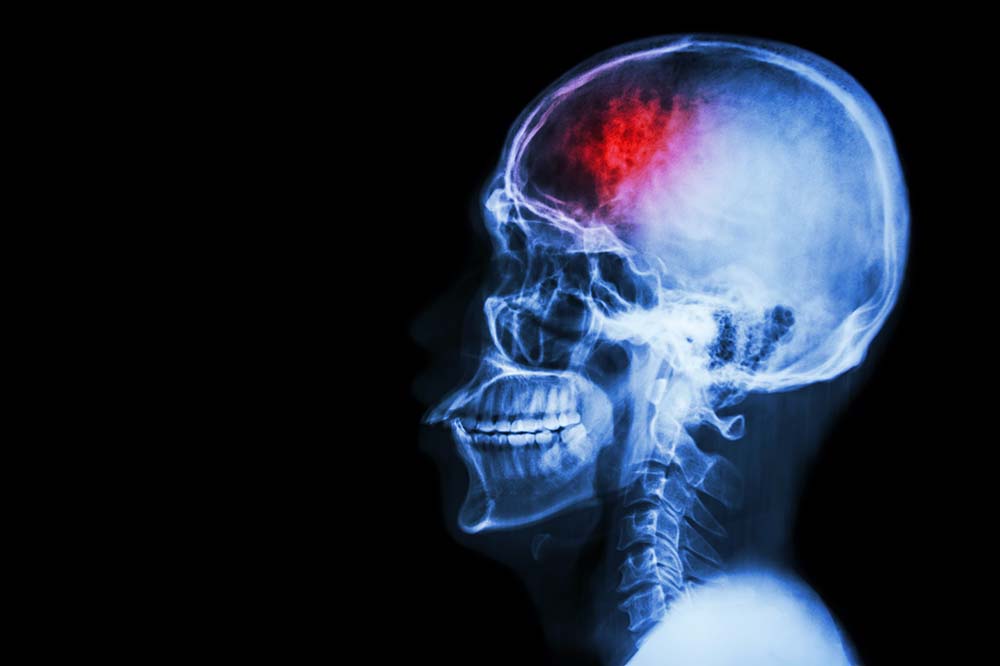 A skull on the right side of a black background. There is a bright red area toward the front of the skull.