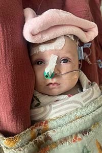 A baby with a pink town on the head and tape and wires across her face looks at the camera.