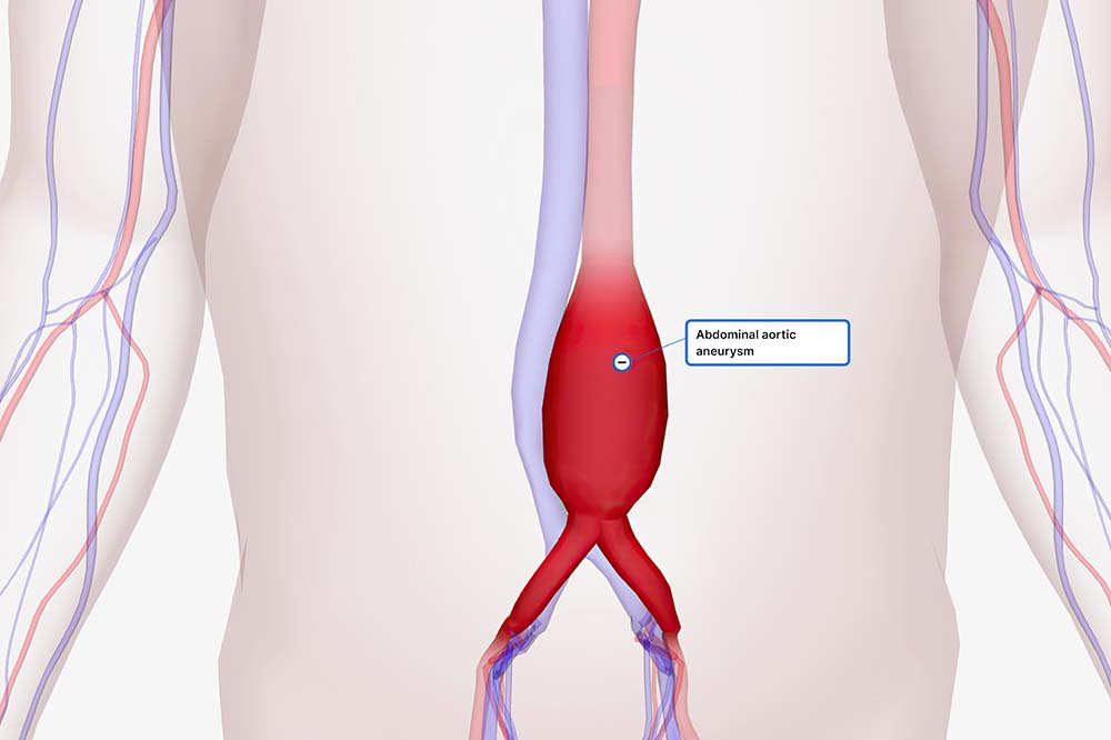Illustration of a torso with showing arteries and a large red area with the words abdominal aortic aneurysm