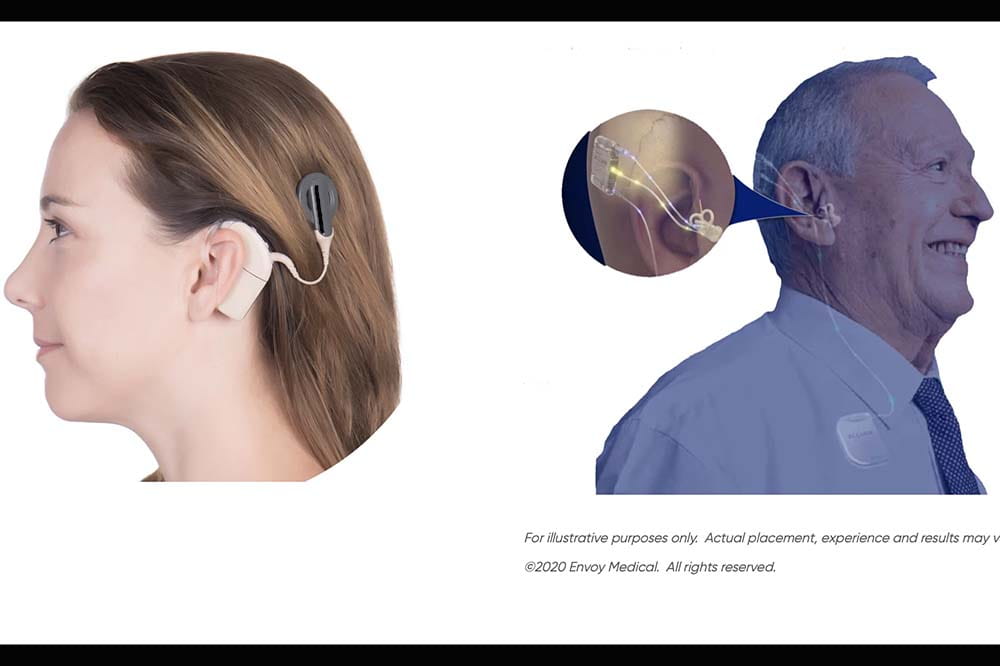 On the left, a woman's head. She has a traditional cochlear implant. On the right, a man's head. He has an Acclaim implant, which is totally under the skin.